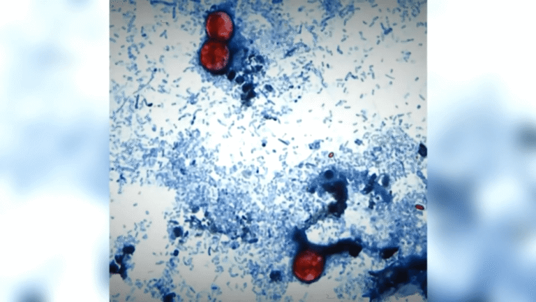 Officials urge caution even as California cyclosporiasis cases not linked to outbreak
