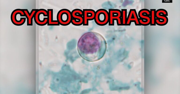 Cyclosporiasis outbreak: What you need to know