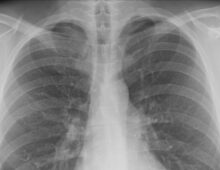 Russian doctors remove chicken bone from North Korean man’s chest
