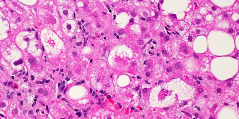 Loss of a metabolic gene protects against fatty liver disease