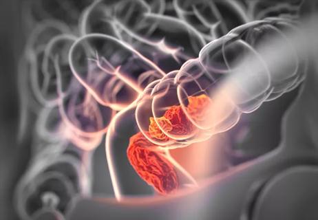The Blood Test Changing Rectal Cancer Surveillance