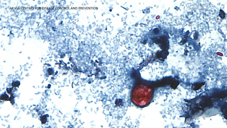 Outbreak of diarrhea caused by cyclosporiasis spreading in US with cases reported in CA, CDC says Outbreak of diarrhea caused by cyclosporiasis spreading in US with cases reported in CA, CDC says