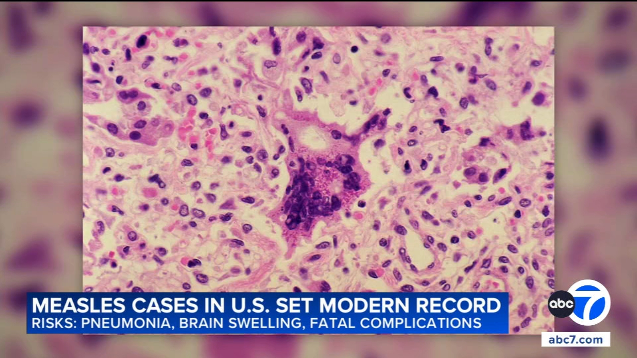 US measles cases reach 35-year high