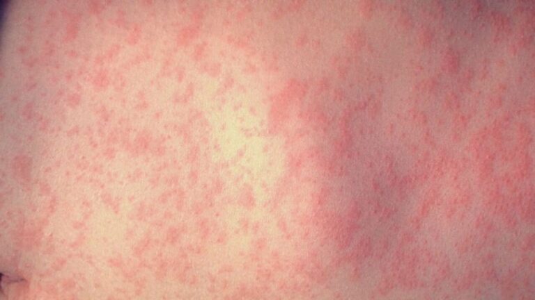 Clark County investigates confirmed measles case in unvaccinated child