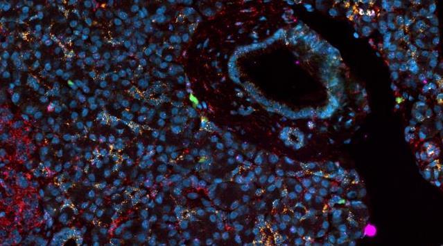 Pancreas organoids reveal CFTR dysfunction as chronic pancreatitis drug target Pancreas organoids reveal CFTR dysfunction as chronic pancreatitis drug target