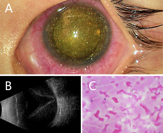 Anterior chamber cholesterolosis in advanced Coats disease Anterior chamber cholesterolosis in advanced Coats disease