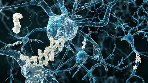 Why Alzheimer’s models may be missing aging