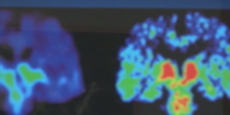 UVA Health researchers identify new approach for brain tumor treatment