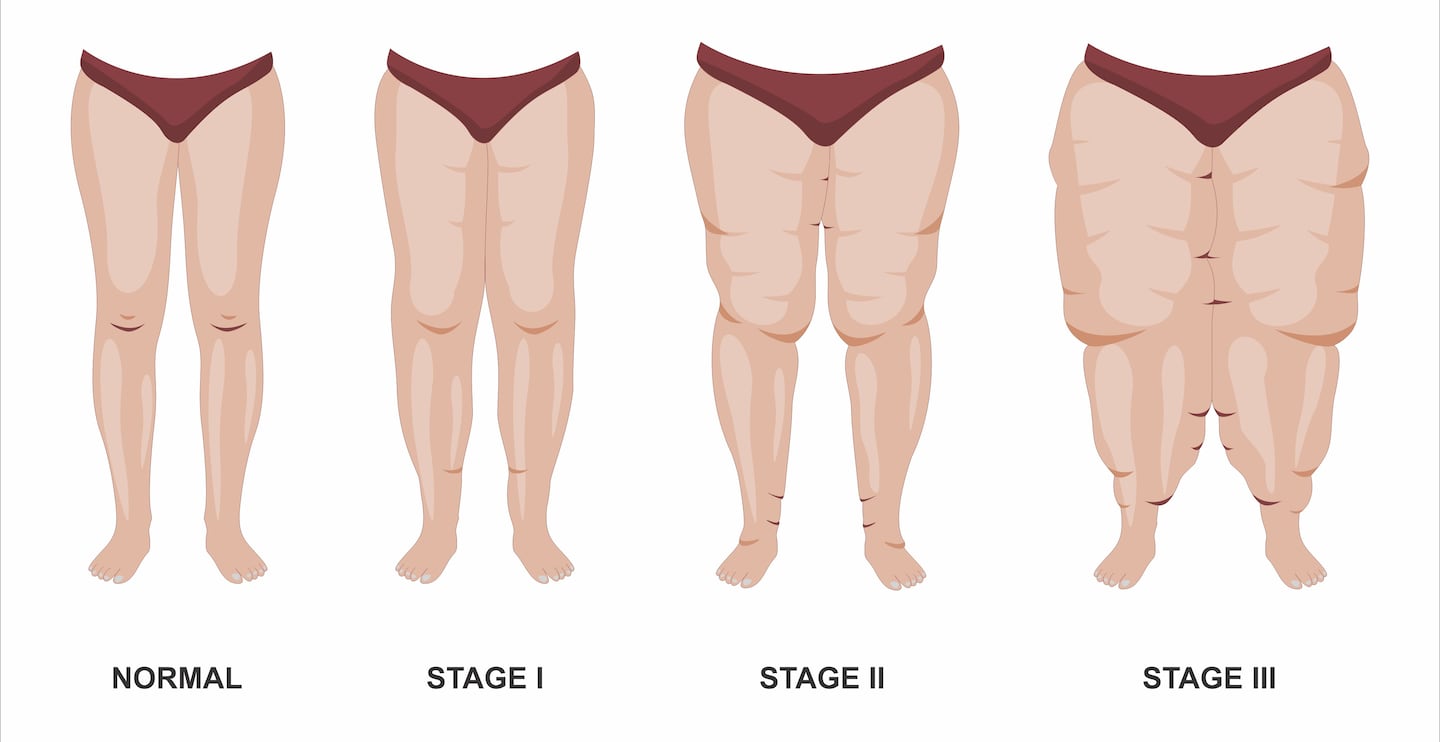 An illustration depicts the stages of lipedema, a chronic disorder that causes abnormal fat accumulation, most commonly in the hips, thighs, and legs. The condition is shown progressing from Stage I to Stage III.