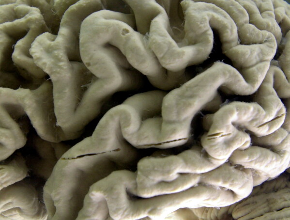 A human brain affected by Alzheimer's disease is displayed at the Museum of Neuroanatomy at the University at Buffalo in Buffalo, N.Y., on Oct. 7, 2003. (AP Photo/David Duprey, File)