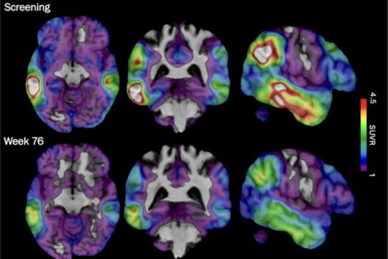 An experimental Alzheimer's drug shows promise targeting a different brain protein, new study shows
