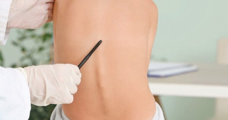 UF Health researchers uncover biological clues behind childhood scoliosis UF Health researchers uncover biological clues behind childhood scoliosis