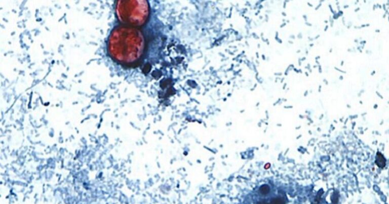 Johnson County leads cyclosporiasis cases as parasitic illness explodes across Kansas