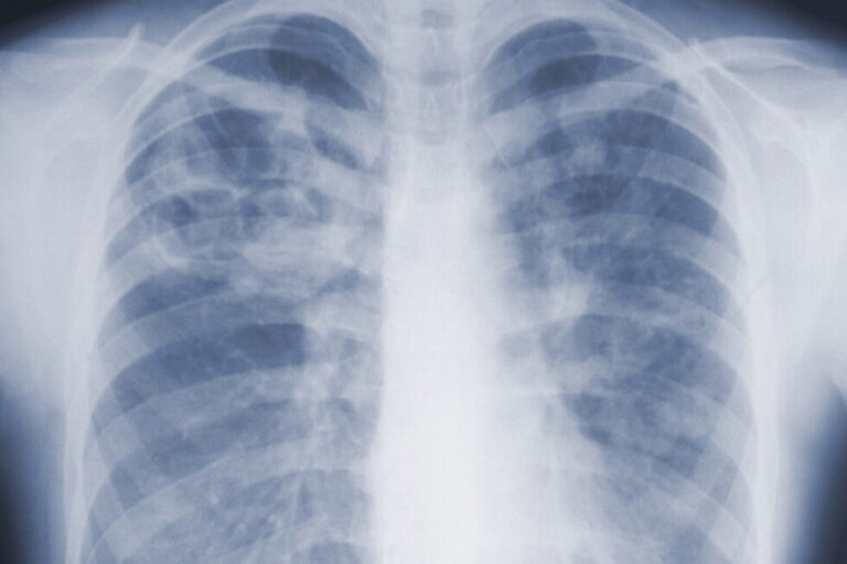Study suggests the threat of mold-associated illnesses may be underappreciated Study suggests the threat of mold-associated illnesses may be underappreciated