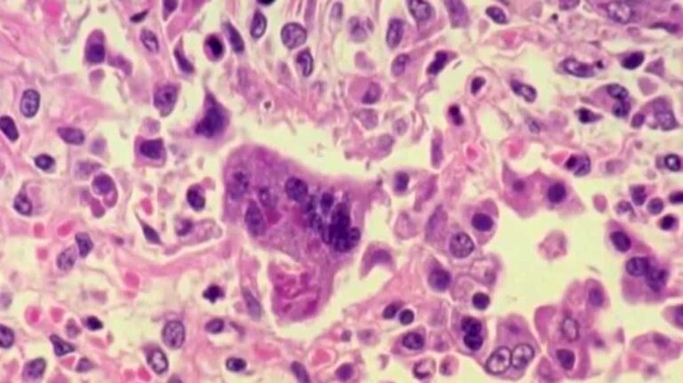Polk County testing dozens for measles after a vaccinated resident is infected Polk County testing dozens for measles after a vaccinated resident is infected