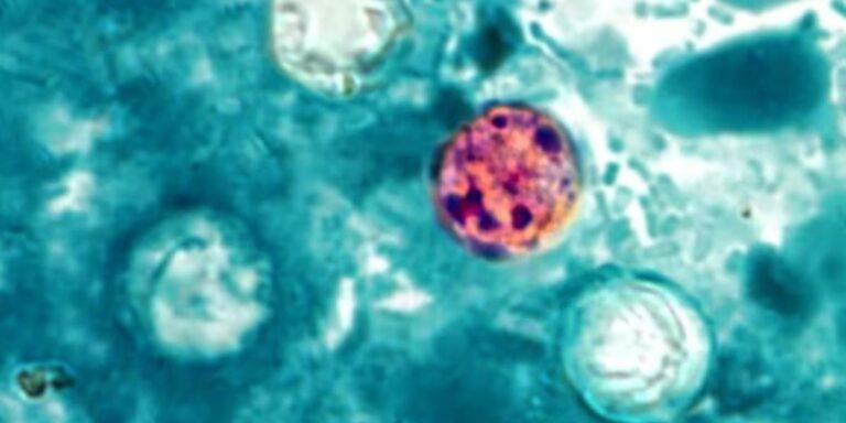 Cyclospora cases rising in summer; Norton Healthcare reports 16 recent diagnoses Cyclospora cases rising in summer; Norton Healthcare reports 16 recent diagnoses