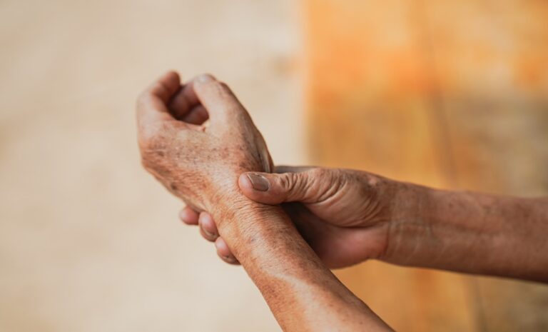 GLP-1 Receptor Agonists in Psoriatic Arthritis Reduce Symptoms