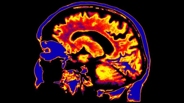 In a First, Chronic Fatigue Syndrome Linked to The Brain’s Clearing System In a First, Chronic Fatigue Syndrome Linked to The Brain's Clearing System