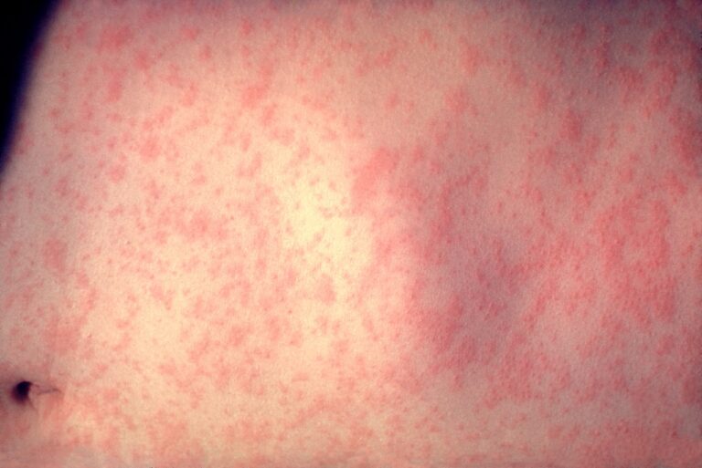 Highly contagious: Viral disease tops 2.3K cases in the US and the numbers are still climbing Highly contagious: Viral disease tops 2.3K cases in the US and the numbers are still climbing