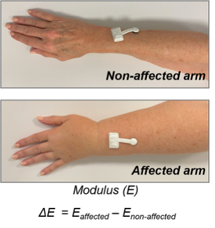 Photo showing both arms of a lymphedema patient with a wireless sensor placed on each arm.