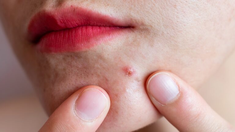 How eczema and acne can affect your mental health How eczema and acne can affect your mental health