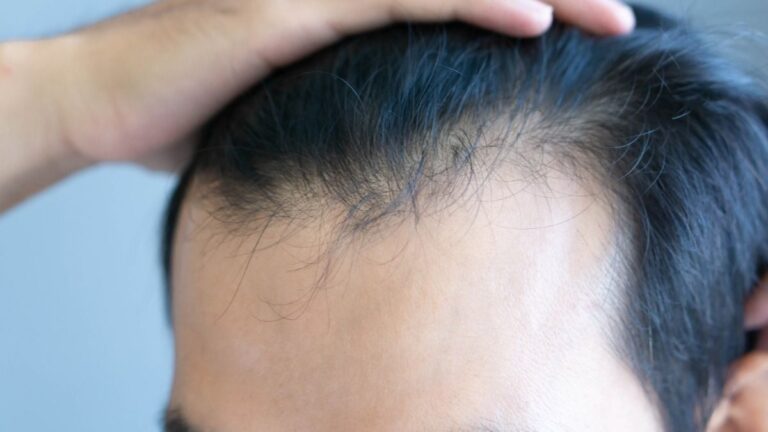 Common Weight Loss Drugs Have Been Linked to a Higher Risk of Hair Loss