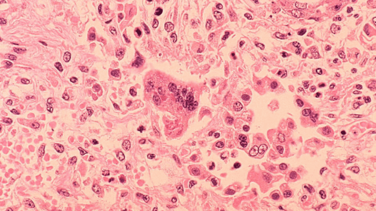 LA County health officials warn of possible measles exposure at LAX LA County health officials warn of possible measles exposure at LAX