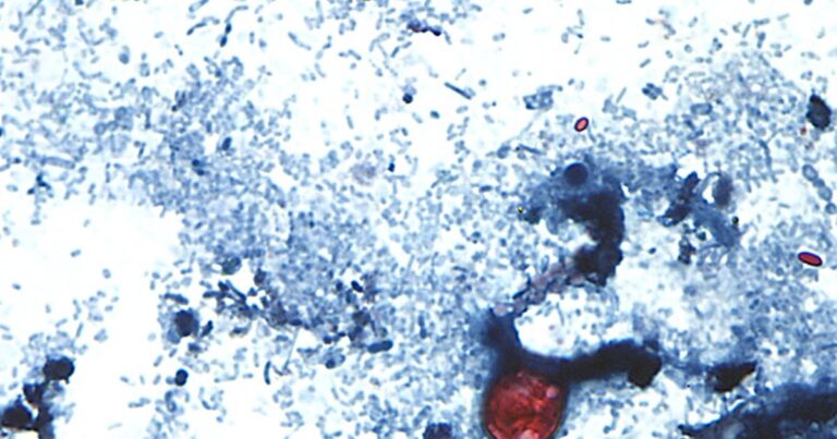 Alaska reports 5 cases of parasitic disease that has sickened thousands nationally
