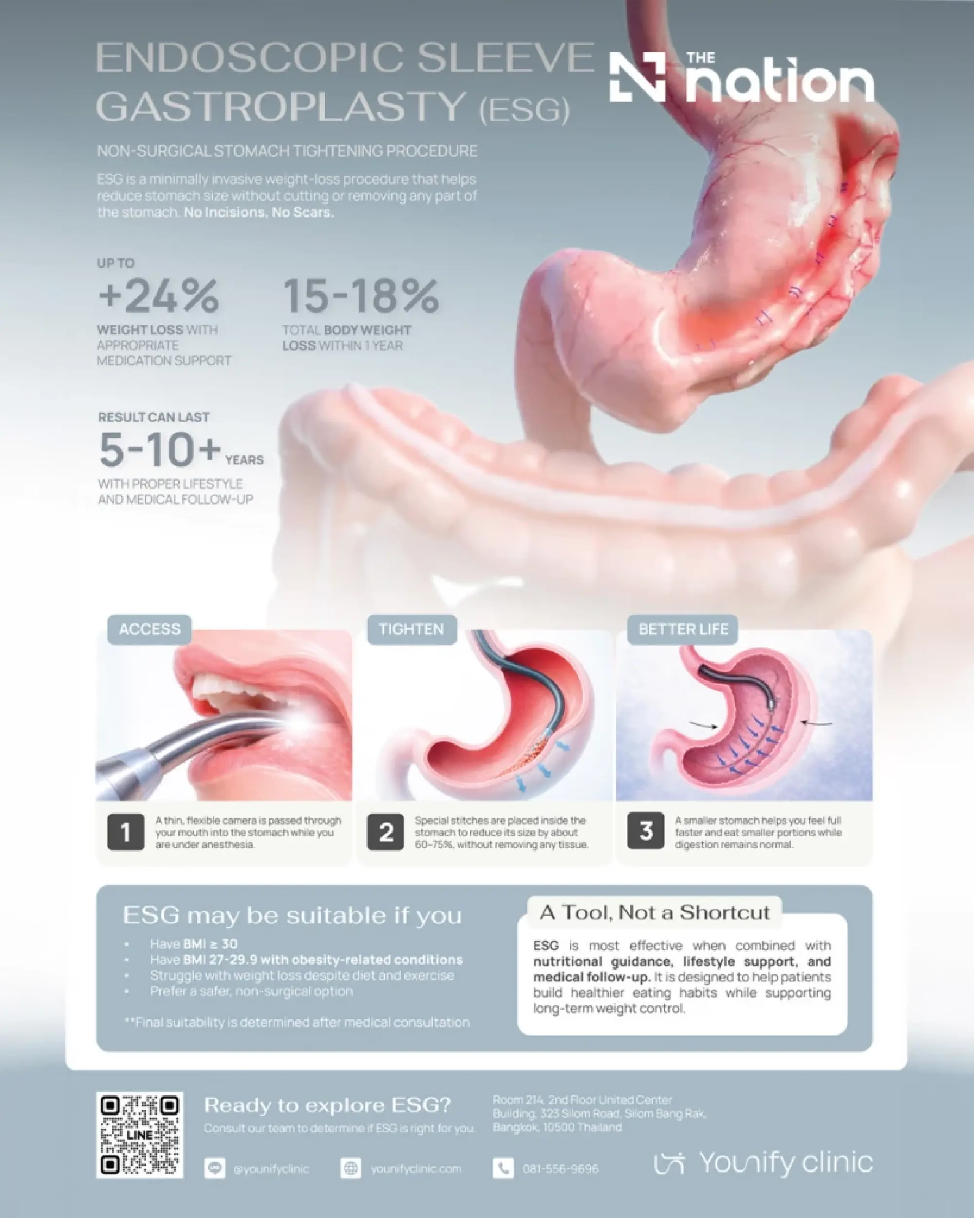 Endoscopic sleeve gastroplasty gains global focus after DDW 2026