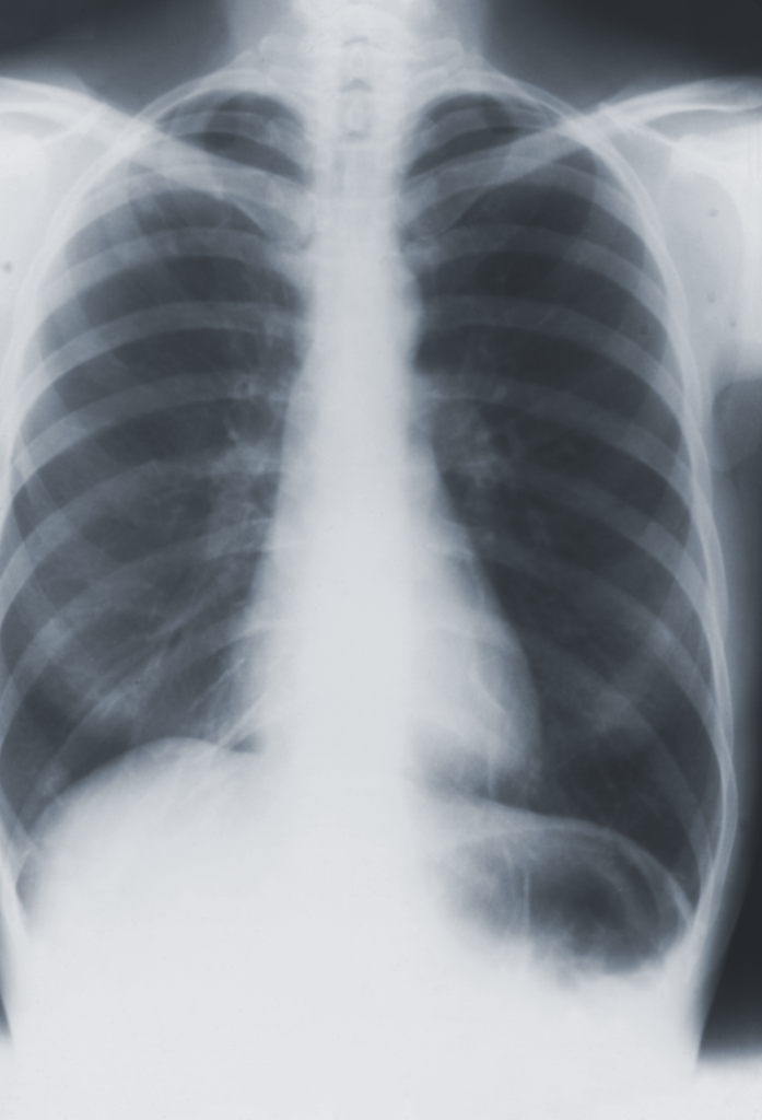 This image depicts an anteroposterior (AP) chest X-ray from a case of pulmonary tuberculosis caused by the bacterium Mycobacterium tuberculosis.