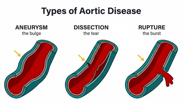 aortic-disease.jpg