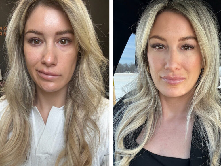 The Medical Minute: A tick bite left her face paralyzed. Specialized treatment helped her smile again