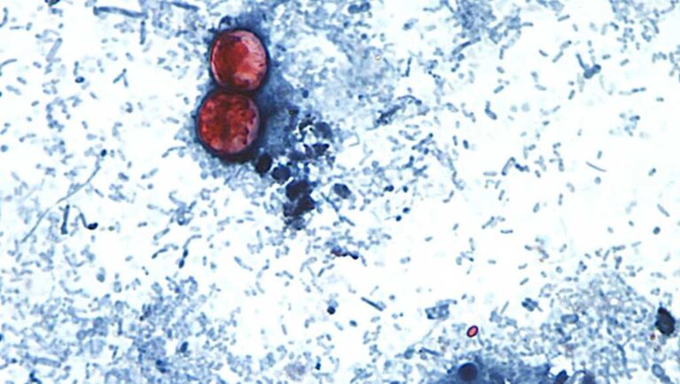 Cyclospora in Maryland: Health officials report 110 cases