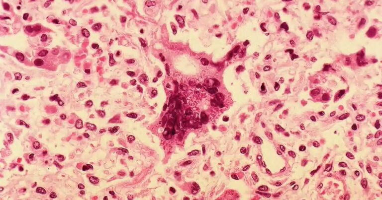 Person with measles traveled through Philadelphia International Airport on Fourth of July, officials say