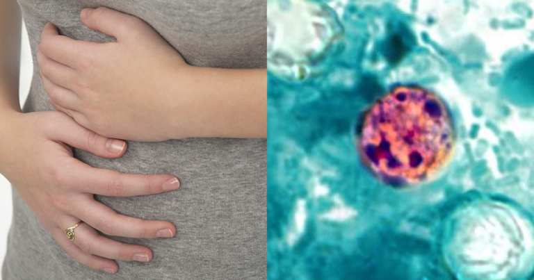 Cyclosporiasis: California now reporting cases of parasite causing ‘explosive diarrhea’ Cyclosporiasis: California now reporting cases of parasite causing 'explosive diarrhea'