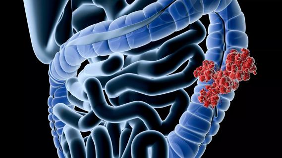 A New Model of Care for Low Anterior Resection Syndrome