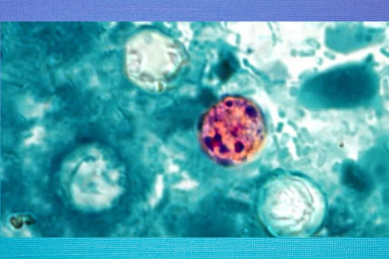 Georgia Department of Public Health and Statesboro Urgent Care provide guidance on Cyclospora parasite Georgia Department of Public Health and Statesboro Urgent Care provide guidance on Cyclospora parasite