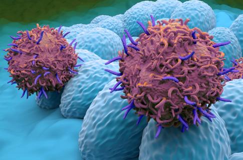illustration of endometrial cancer