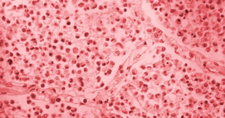 Upper East Side Legionnaires’ outbreak jumps to 54 cases as cooling towers investigated Upper East Side Legionnaires’ outbreak jumps to 54 cases as cooling towers investigated