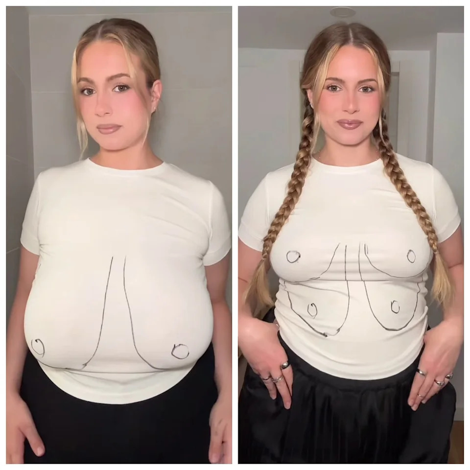 Ellen Larson shows the difference in her breast height before and after her surgery. / Instagram/Ellen Larson