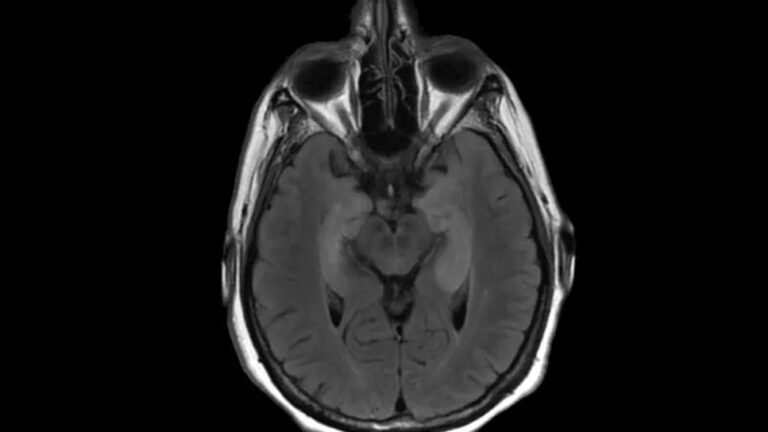 Study Links ANNA1/Hu-IgG Paraneoplastic Neurological Syndromes With Longer Cancer Survival