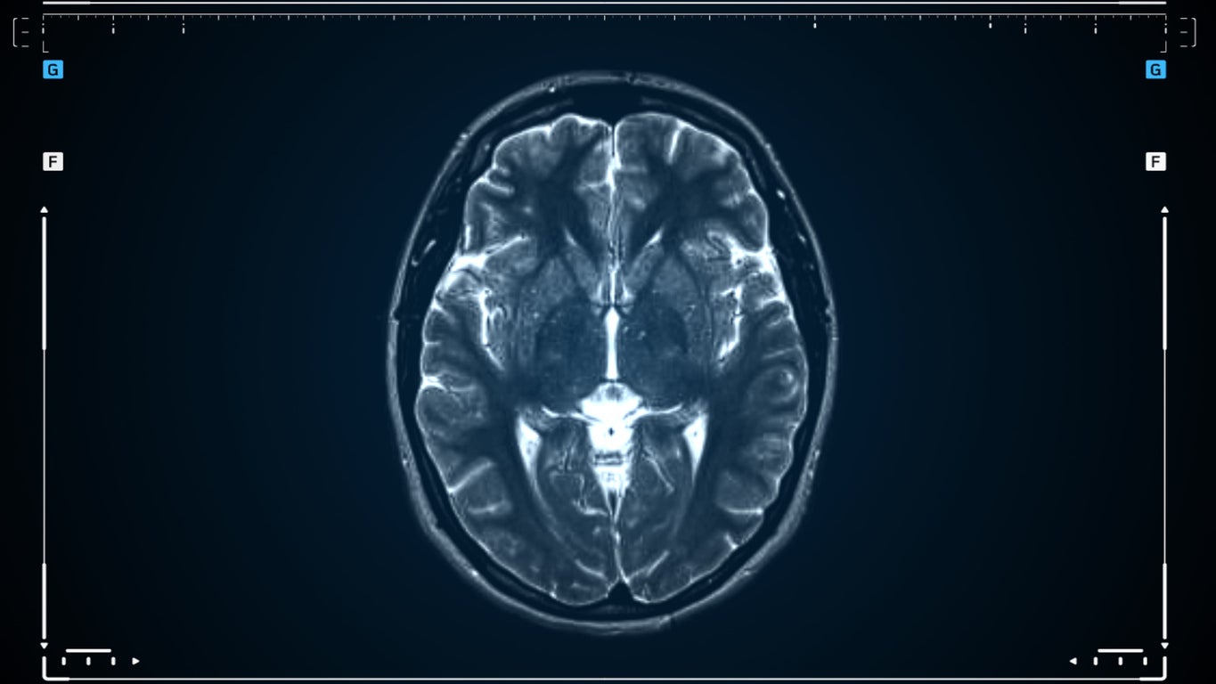 In France, cerebral small vessel disease is estimated to affect more than 5 million people aged 65 and over