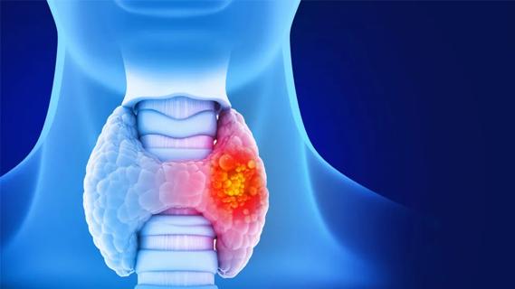 Thyroid cancer illustration
