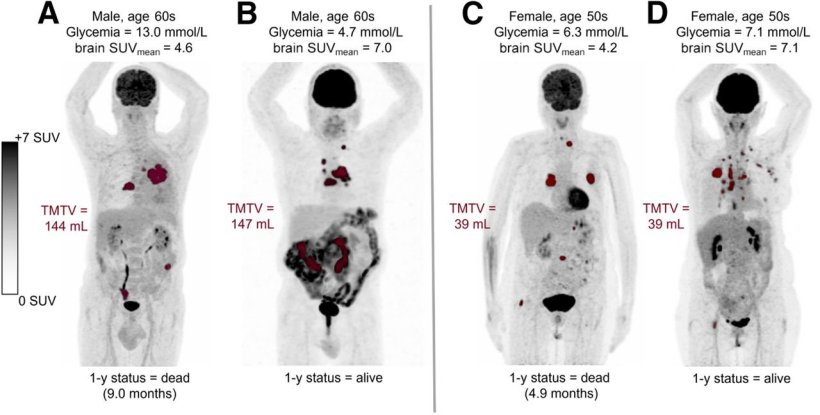 Examples of baseline 18F-FDG PET images of four patients with metastatic NSCLC....