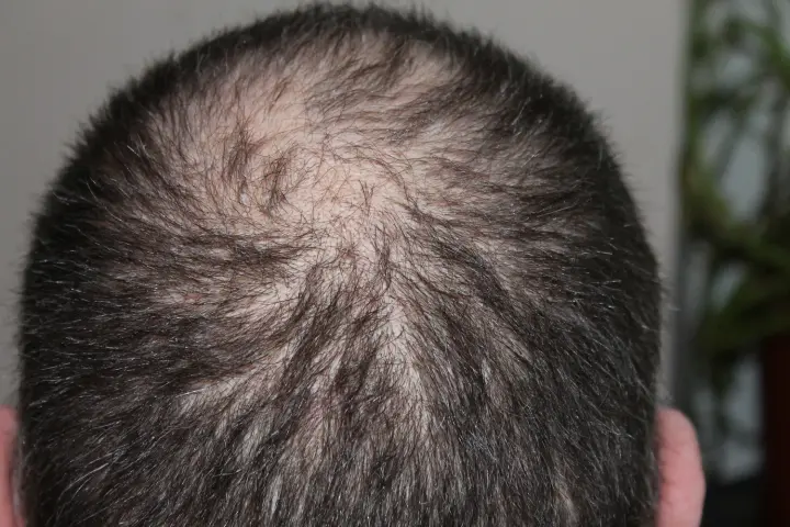Weight loss drugs increase the risk of hair loss - study