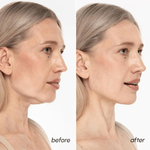 MAREE V Line Lifting Mask with 24K Gold