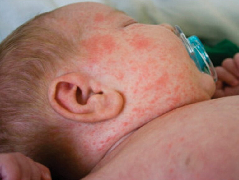 Measles in Babies: Symptoms, Treatment & Prevention