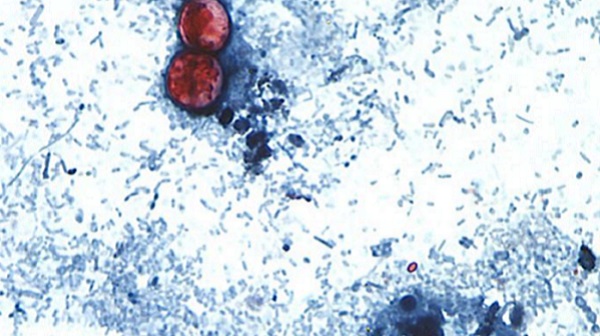 Dallas County confirms nine cyclosporiasis cases, more under investigation Dallas County confirms nine cyclosporiasis cases, more under investigation