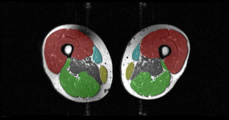 MRI reveals muscle loss related to weight fluctuations