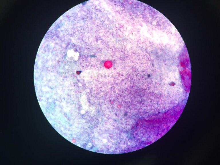 Diarrhea Parasite Outbreak: Expert Speaks On What To Know, How To Stay Safe